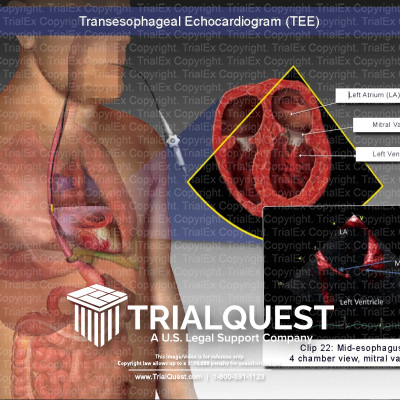 Transesophageal Echocardiogram (TEE)