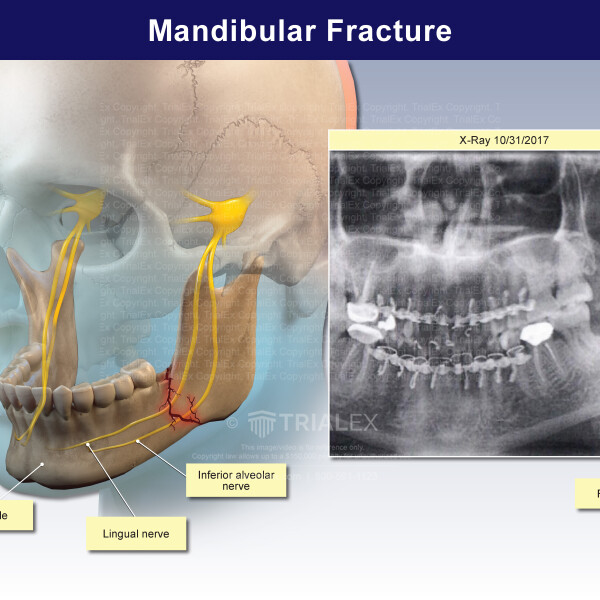 Mandibular Fracture