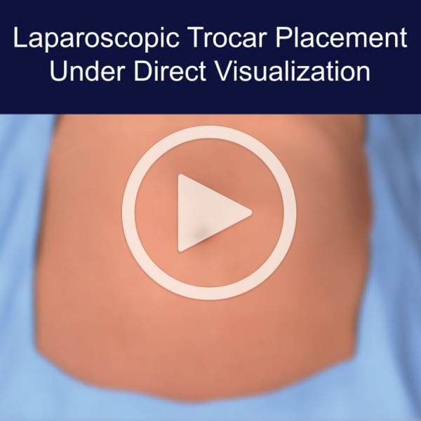 Laparoscopic Trocar Placement Under Direct Visualization