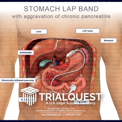 Stomach LAP Band with Aggravation of Chronic Pancreatitis