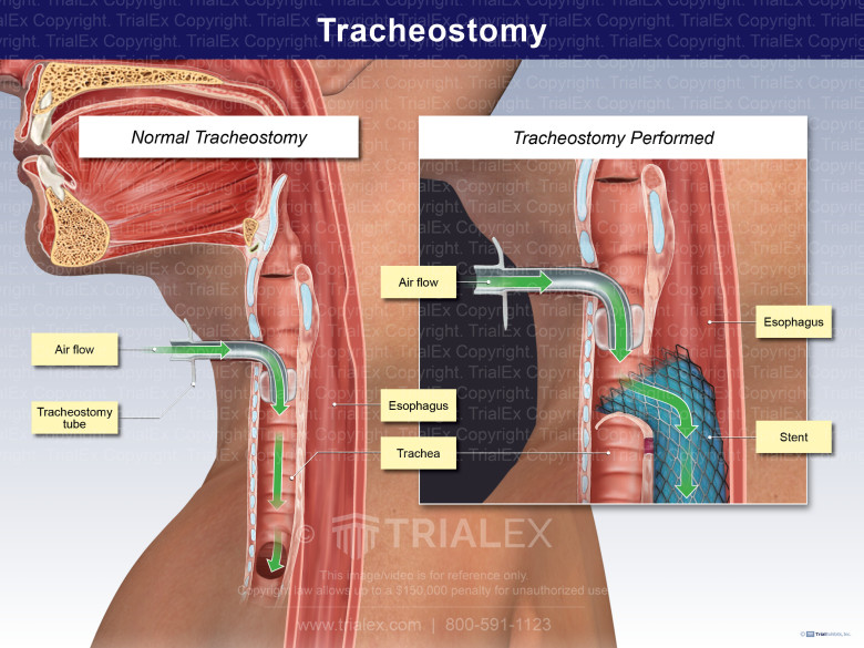 Tracheostomy