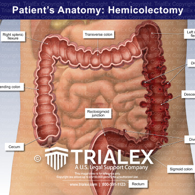 Patient's Anatomy: Hemicolectomy