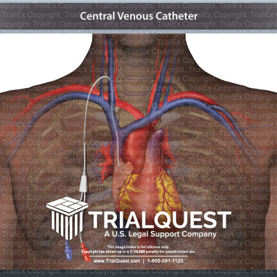 Central Venous Catheter - vrogue.co