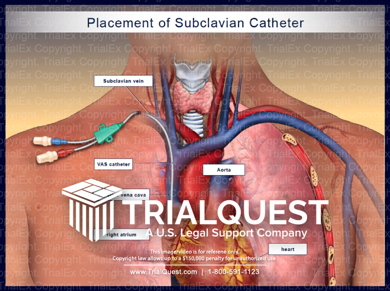 Triple lumen catheter vs picc line - nerystep