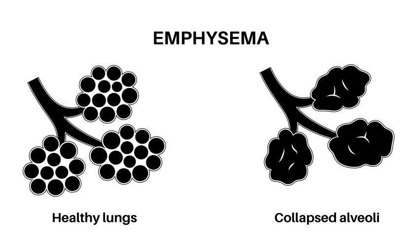 Emphysema anatomical poster Royalty Free Vector Image