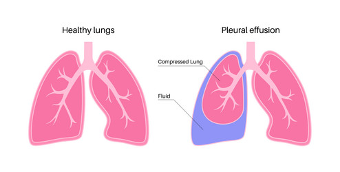 Pleural effusion poster Royalty Free Vector Image