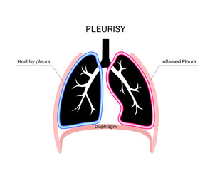 Lung Inflammation Vector Images (over 2,200)