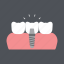 dental, dentist, health, implant, medical, molar, tooth