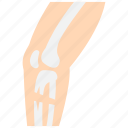 orthopedics, bone, broken, leg