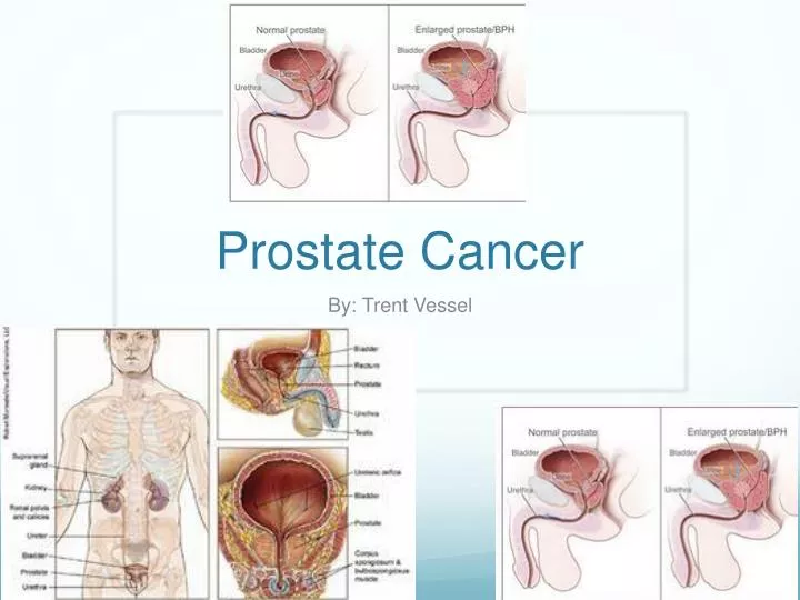 prostate cancer