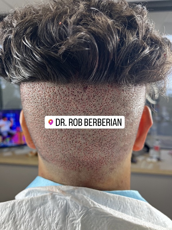 trypophobia-fade-dr.-rob-berberian-6s-fue-hair-transplant-los-angeles-newport-beach.jpg