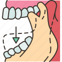 jaw, clicking, popping, temporomandibular, disorder