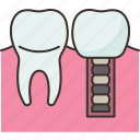 implant, tooth, crown, dentistry, treatment