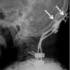 craniocervical instability surgery