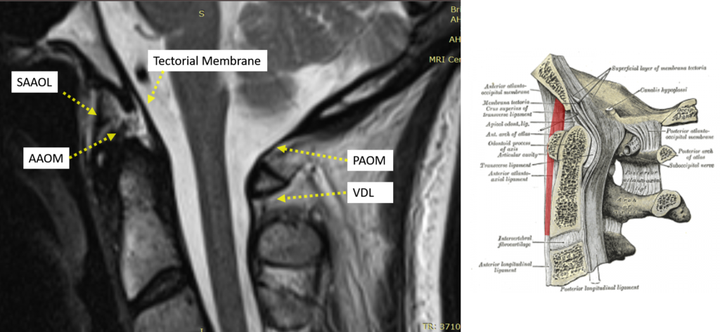 Anterior Atlanto Occipital Membrane