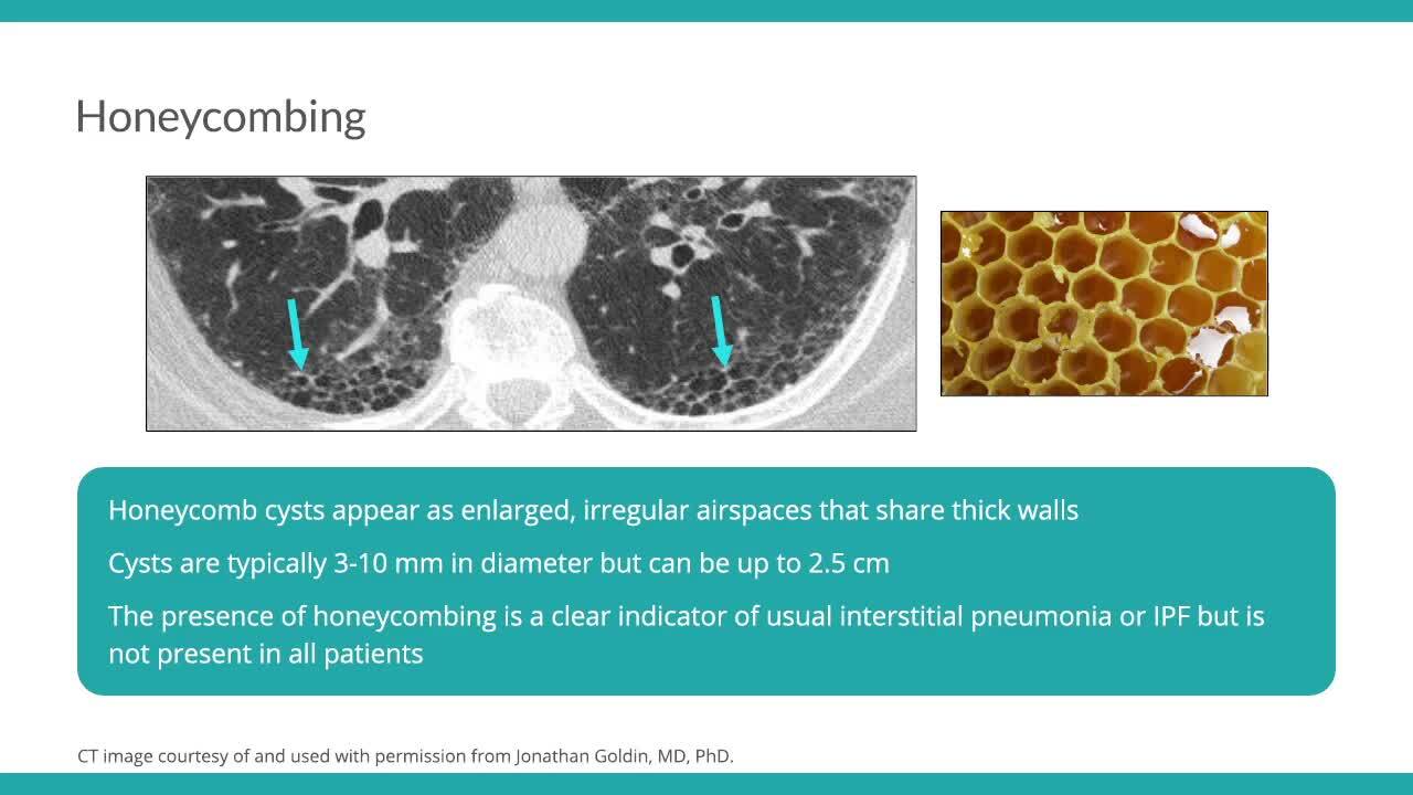 Idiopathic Pulmonary Fibrosis Honeycomb