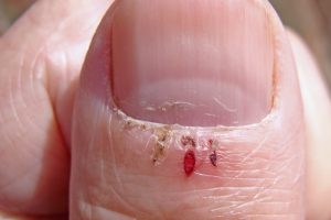 hangnail