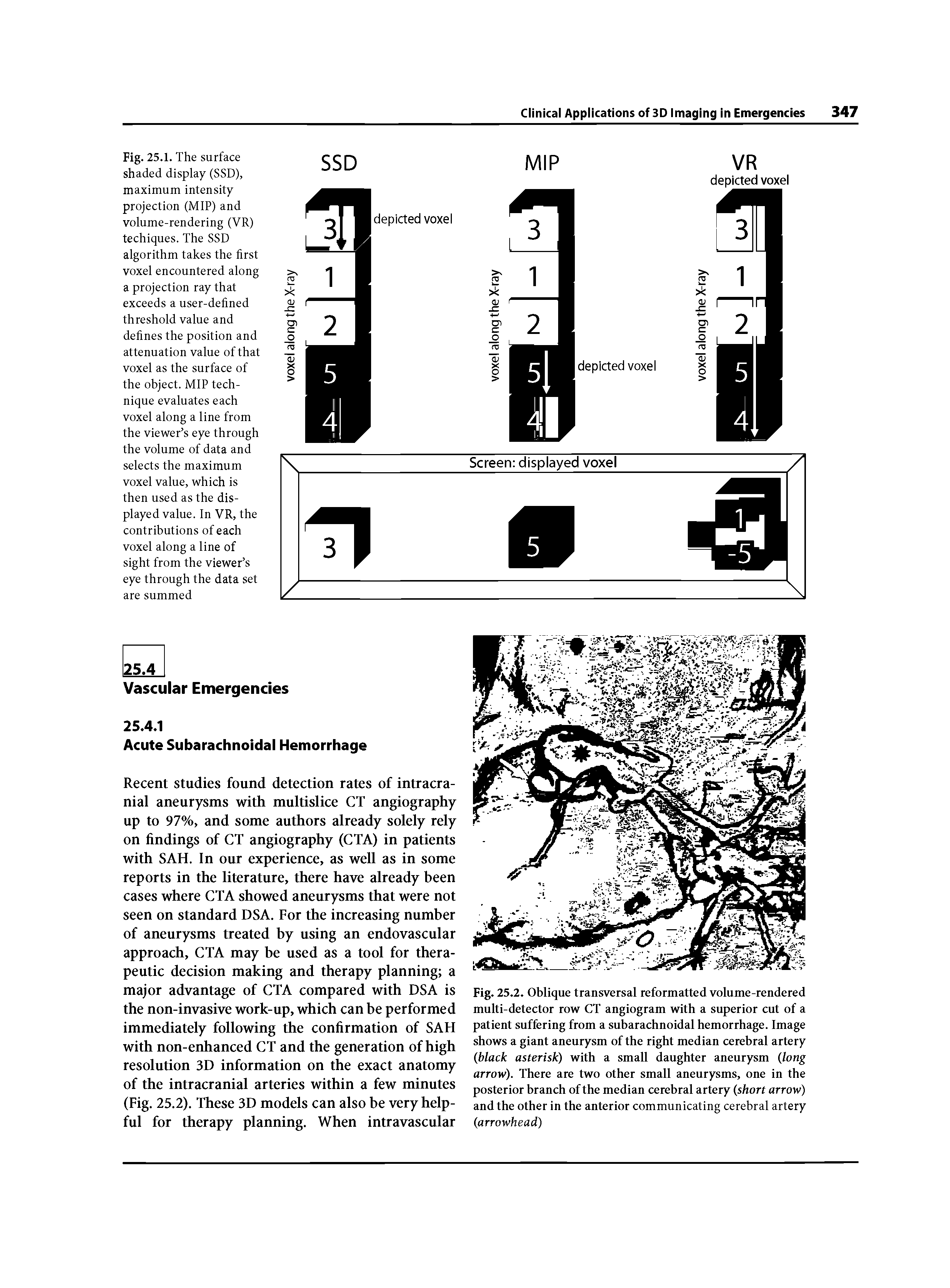 Fig. 25.1. The surface shaded display (SSD), maximum intensity projection (MIP) and volume-rendering (VR) techiques. The SSD algorithm takes the first voxel encountered along a projection ray that exceeds a user-defined threshold value and defines the position and attenuation value of that voxel as the surface of the object. MIP technique evaluates each voxel along a line from the viewer s eye through the volume of data and selects the maximum voxel value, which is then used as the displayed value. In VR, the contributions of each voxel along a line of sight from the viewer s eye through the data set are summed...