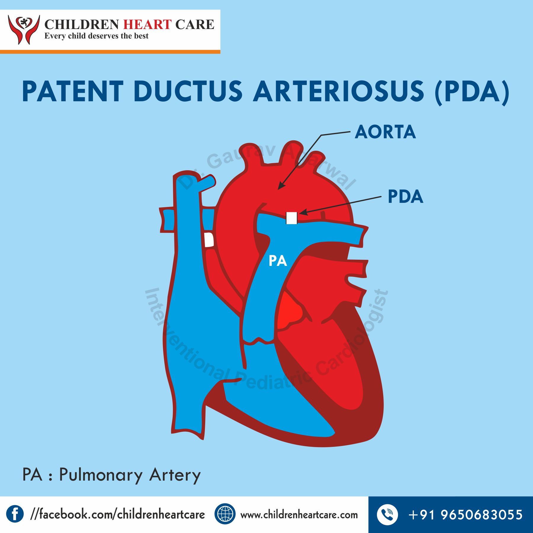 Patent Ductus Arteriosus Pathophysiology