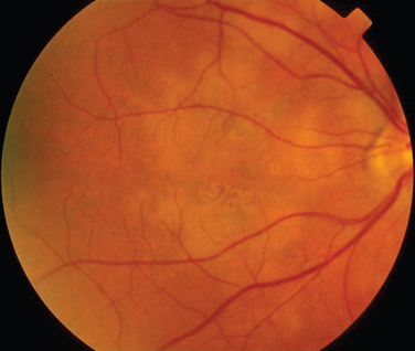 RETINAL DISEASE | Clinical Gate