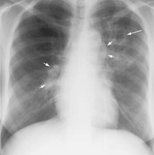 Tuberculosis and Nontuberculous Mycobacterial Infections | Clinical Gate