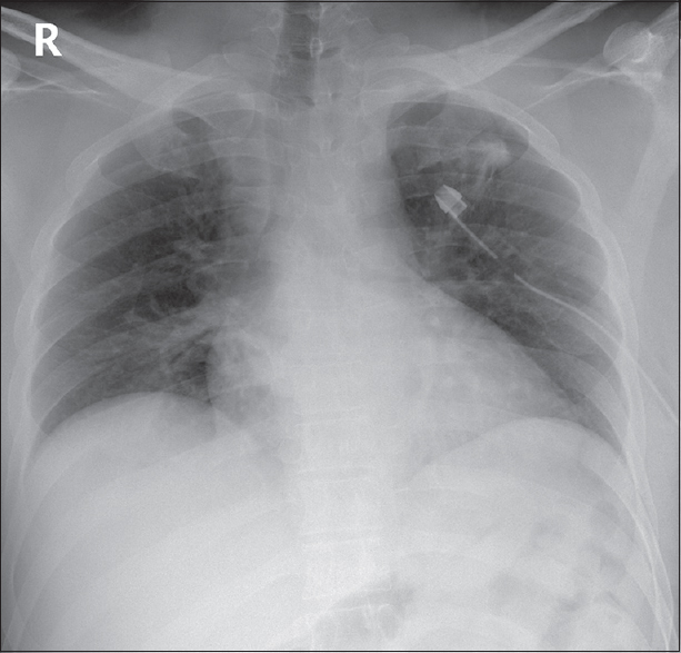 Computed Tomography-guided Pulmonary Nodule Microcoil Localization ...