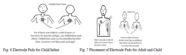 aed pad placement.