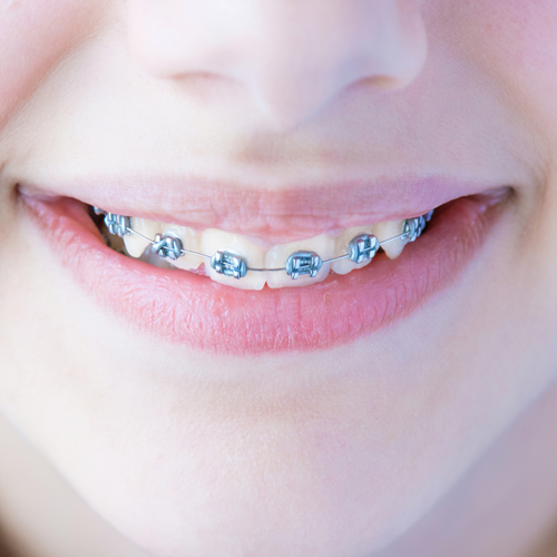 Orthodontic Treatment.