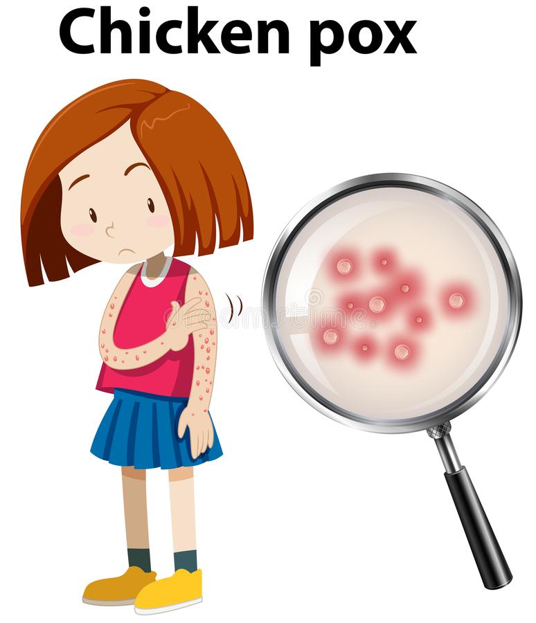 Chicken Pox Stock Illustrations.