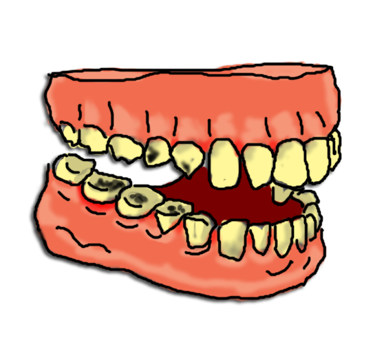 Tooth Decay Clipart.