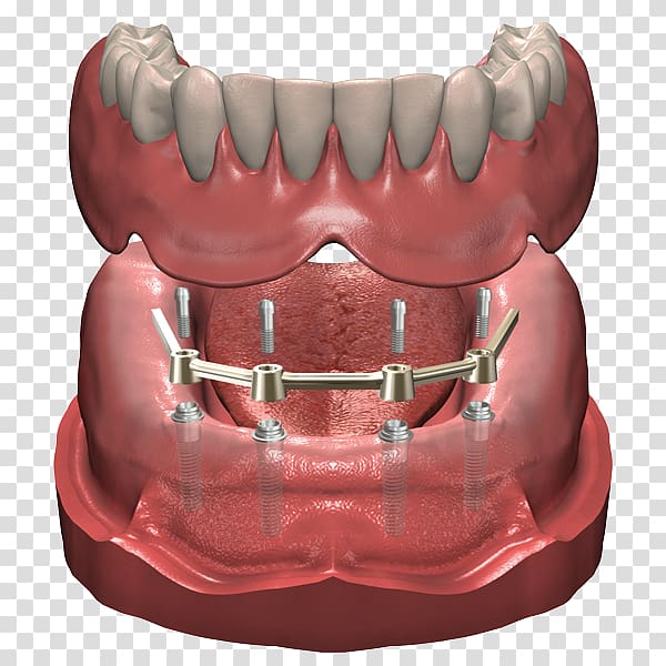 Dentures Dental implant Prosthesis Dentist, Implant transparent.