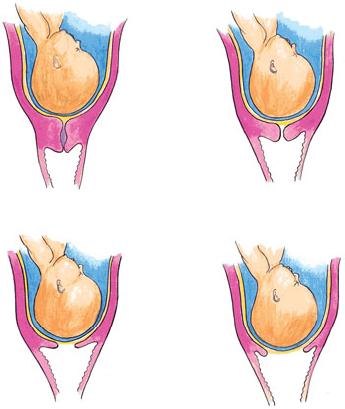 cervical effacement Images, Graphics, Comments and Pictures.