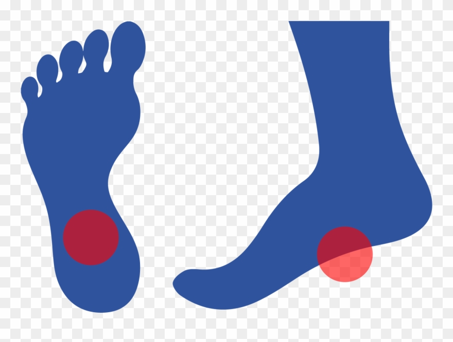 Plantar Fasciitis Is Caused By Inflammation Of A Thick Clipart.