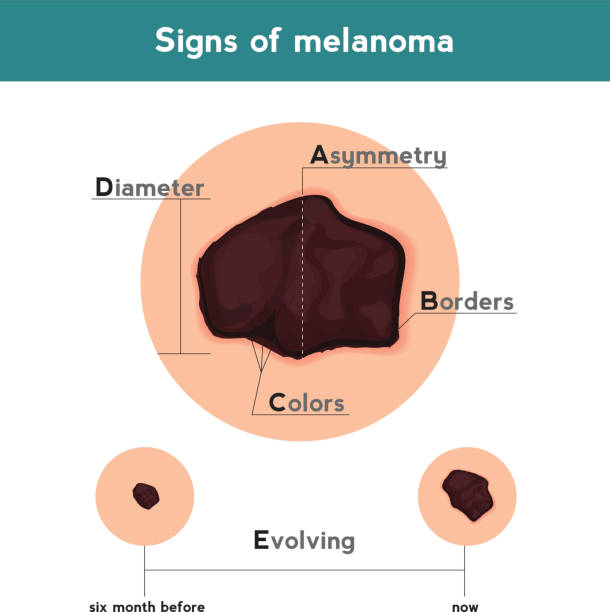 Best Melanoma Illustrations, Royalty.