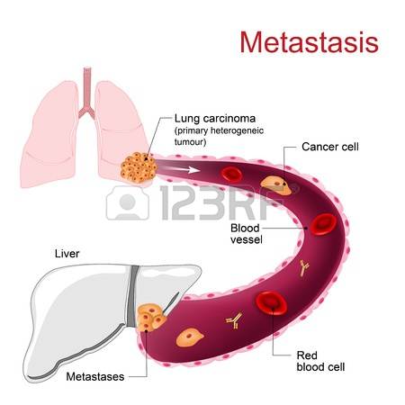 3,531 Lung Cancer Cliparts, Stock Vector And Royalty Free Lung.