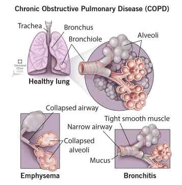 Understanding COPD: A Guide for Families