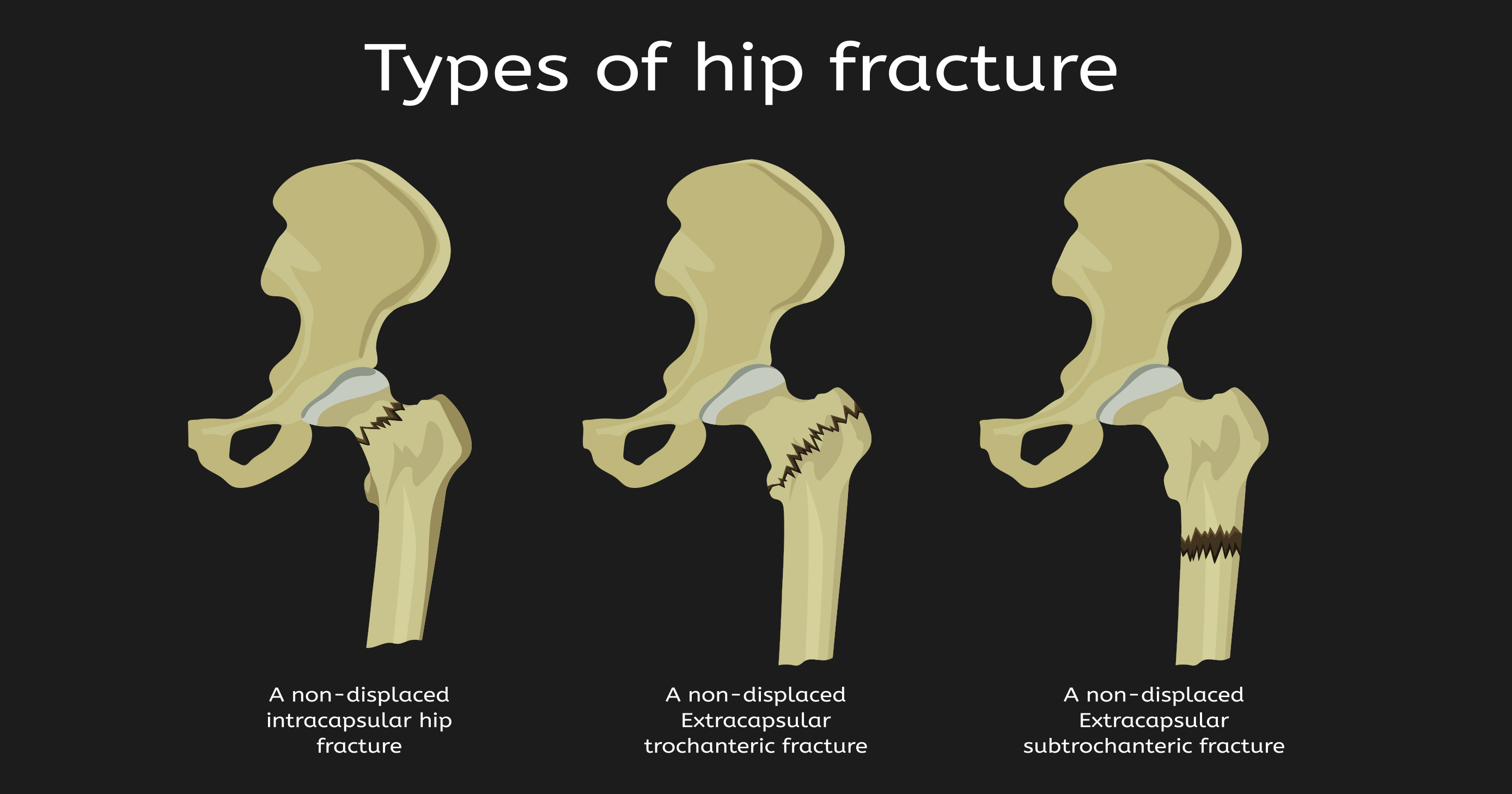 Using a tuning fork for fractures - textbatman