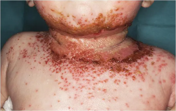 Baby with acute eczema.