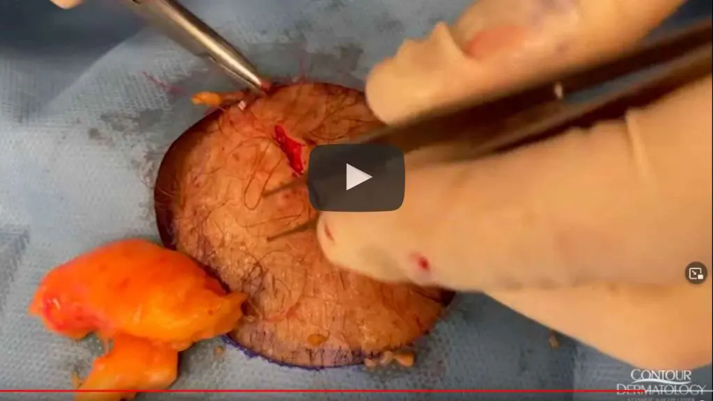 Dr. Timothy Jochen extracts a lipoma that looks like a lobster!