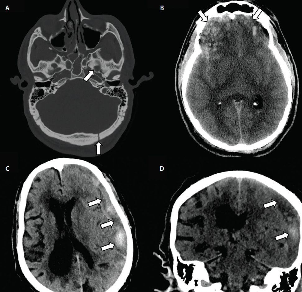 Traumatic Brain Injury Mri