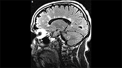 lateral ventricle abutting lesions cover