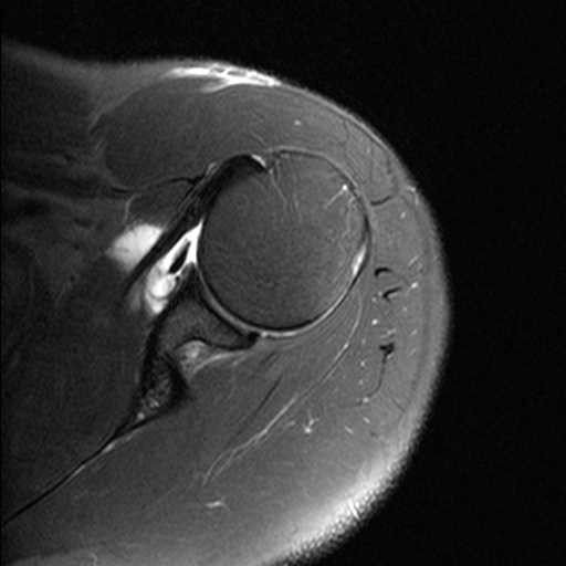 Type 2 SLAP Tear - Body MR Case Studies - CTisus CT Scanning