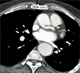 Coronary Artery Aneurysm - Cardiac Case Studies - CTisus CT Scanning