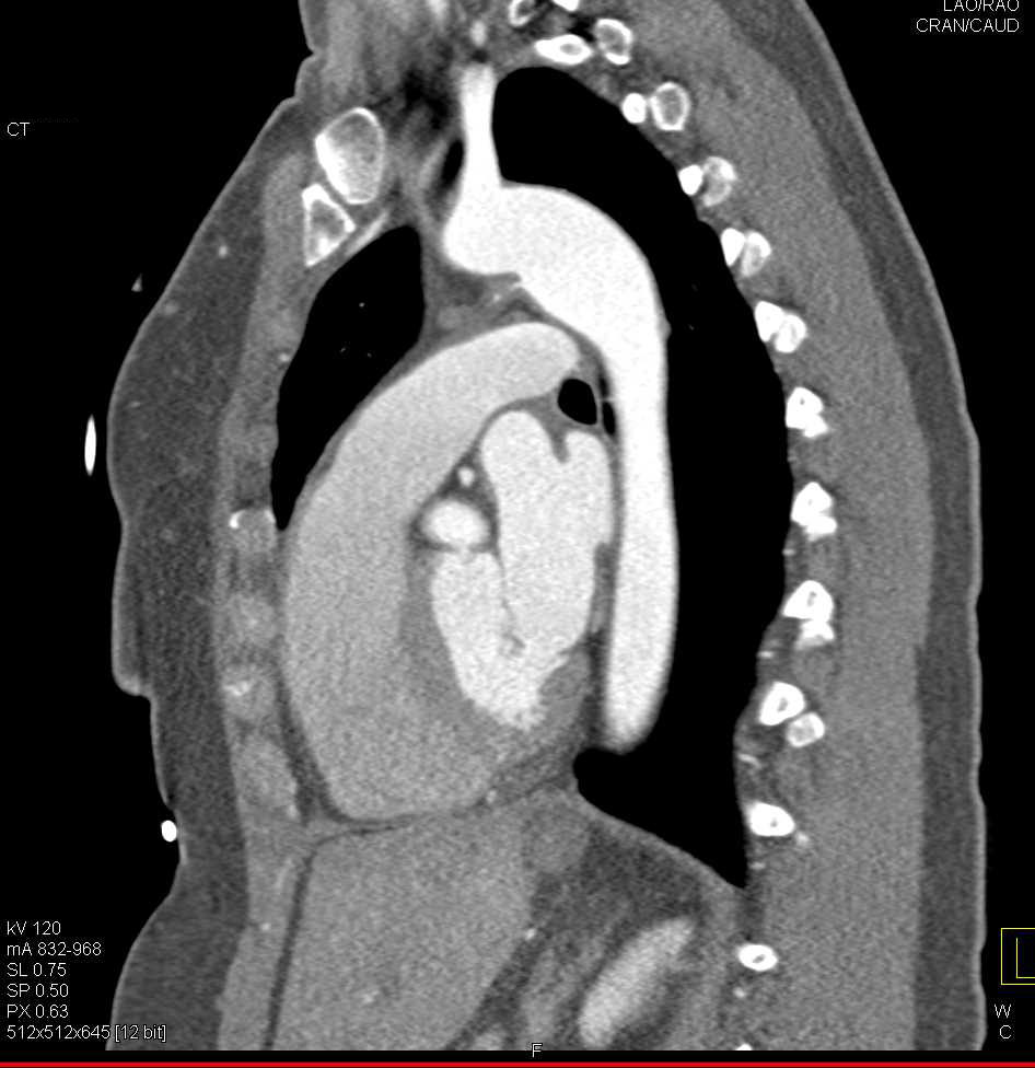 PDA or Patent Ductus Arteriosus - Cardiac Case Studies - CTisus CT Scanning