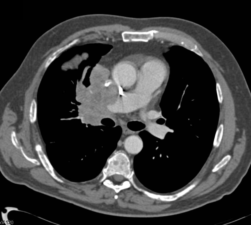 Small Cell Lung Cancer Chest X Ray