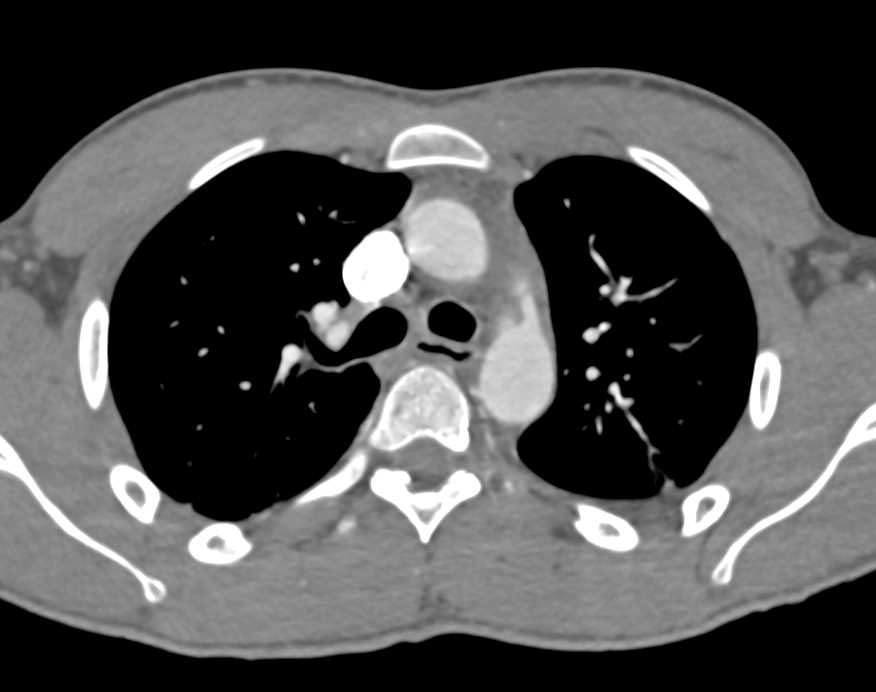 Patent Ductus Arteriosus Ct