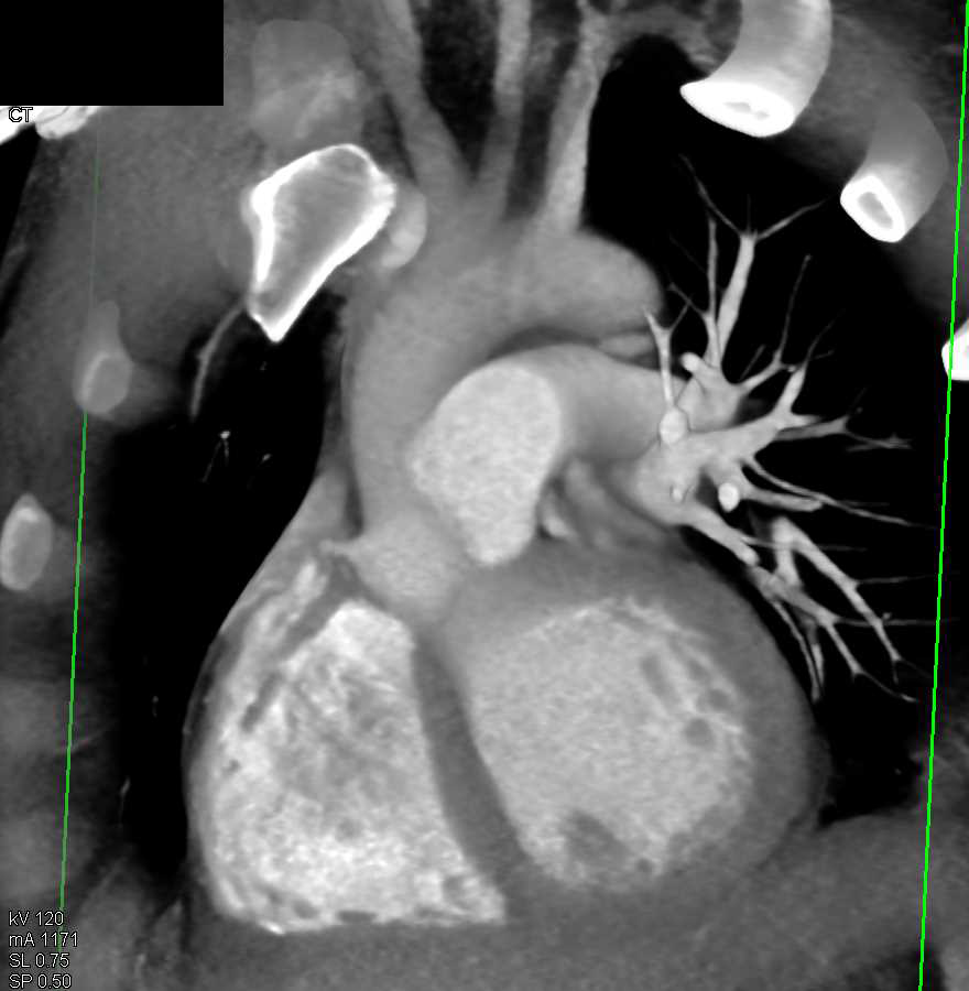 Patent Ductus Arteriosus (PDA) - Chest Case Studies - CTisus CT Scanning