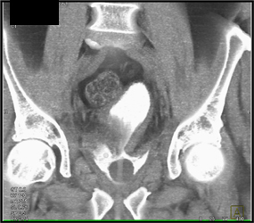 Extravasation of Contrast From the Bladder - Kidney Case Studies ...