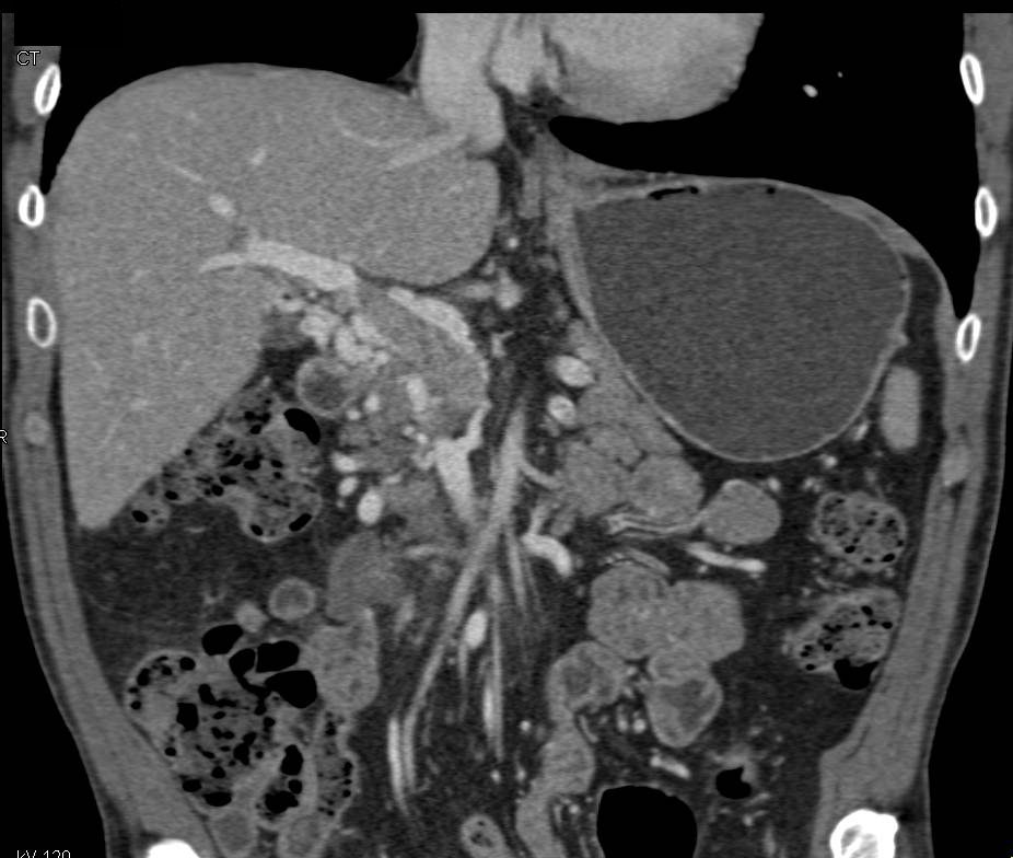 Portal Vein Thrombosis with Cavernous Transformation of the Portal Vein ...