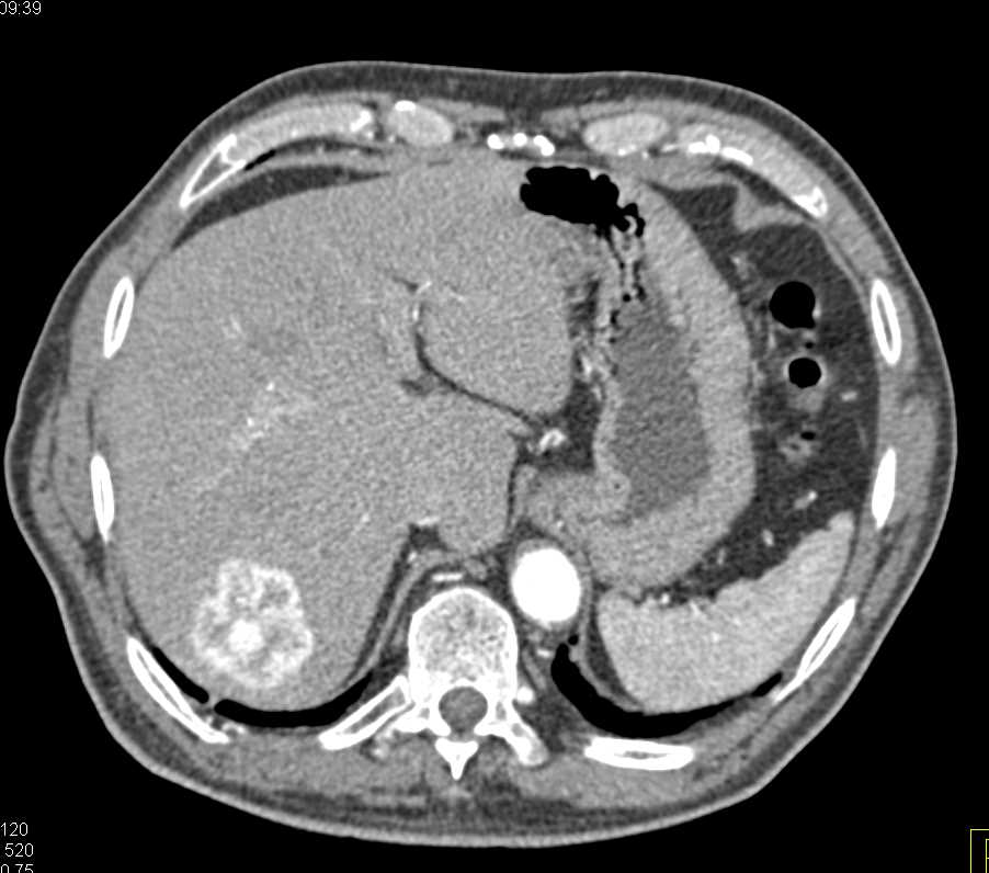 Hepatic Hemangioma Ultrasound